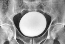 Гігантський камінь сечового міхура видалено з Ірану